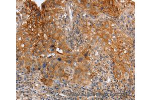 Immunohistochemistry of Human cervical cancer using PLAUR Polyclonal Antibody at dilution of 1:60