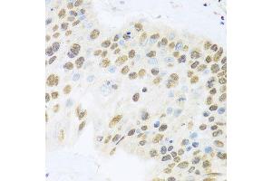 Immunohistochemistry of paraffin-embedded human lung cancer using ZBTB17 antibody (ABIN5974597) at dilution of 1/100 (40x lens). (ZBTB17 antibody)