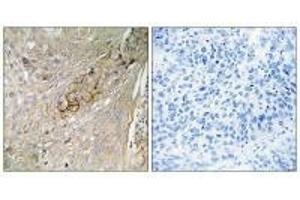 Immunohistochemistry analysis of paraffin-embedded human lung carcinoma tissue using SC6A6 antibody. (TAUT antibody)