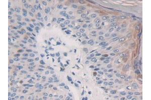 DAB staining on IHC-P; Samples: Human Skin cancer Tissue (GAB3 antibody  (AA 332-583))