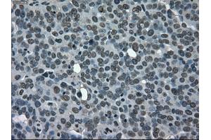Immunohistochemical staining of paraffin-embedded Adenocarcinoma of ovary tissue using anti-CD4mouse monoclonal antibody. (CD4 antibody)