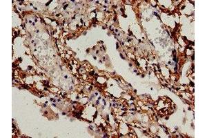 Immunocytochemistry analysis of human lung cancer using ABIN7145302 at dilution of 1:100 (BIM antibody  (AA 1-198))