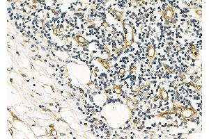 ABIN6259756 and ABIN6278092 at 1/100 staining Human pancreatic cancer by IHC-P.
