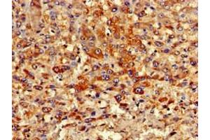 Immunohistochemistry of paraffin-embedded human liver cancer using ABIN7162982 at dilution of 1:100 (PIPOX antibody  (AA 259-337))