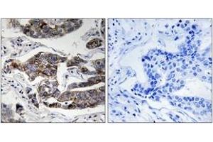 Immunohistochemistry analysis of paraffin-embedded human breast carcinoma, using Girdin (Phospho-Ser1417) Antibody. (Girdin antibody  (pSer1417))