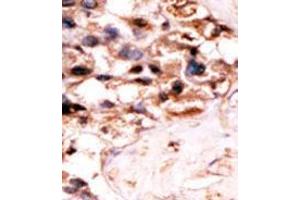 Formalin-fixed and paraffin-embedded human cancer tissue´(hepatocarcinoma) reacted with the primary antibody, which was peroxidase-conjugated to the secondary antibody, followed by DAB staining. (UCKL1 antibody  (N-Term))