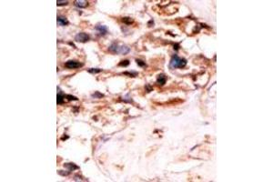 Formalin-fixed and paraffin-embedded human cancer tissue´(hepatocarcinoma) reacted with the primary antibody, which was peroxidase-conjugated to the secondary antibody, followed by DAB staining.