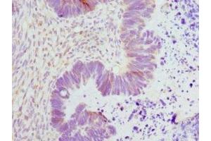 Immunohistochemistry of paraffin-embedded human ovarian cancer using ABIN7151362 at dilution of 1:100 (ENOX2 antibody  (AA 411-610))