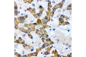 Immunohistochemical analysis of HAO1 staining in human liver cancer formalin fixed paraffin embedded tissue section. (HAO1 antibody)