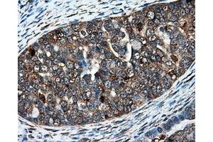 Immunohistochemical staining of paraffin-embedded Adenocarcinoma of colon tissue using anti-IFT57mouse monoclonal antibody.