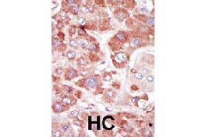 Formalin-fixed and paraffin-embedded human hepatocellular carcinoma tissue reacted with GRK7 polyclonal antibody  , which was peroxidase-conjugated to the secondary antibody, followed by AEC staining.