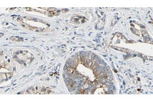ABIN6278142 at 1/100 staining Human prostate tissue by IHC-P. (PTP4A2 antibody  (Internal Region))
