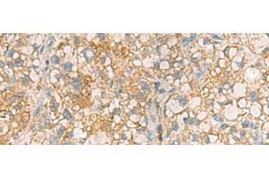 Immunohistochemistry of paraffin-embedded Human liver cancer tissue using ANXA13 Polyclonal Antibody at dilution of 1:105(x200) (Annexin A13 antibody)