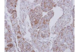 IHC-P Image Immunohistochemical analysis of paraffin-embedded human colon carcinoma, using NDUFS2, antibody at 1:250 dilution. (NDUFS2 antibody  (Center))