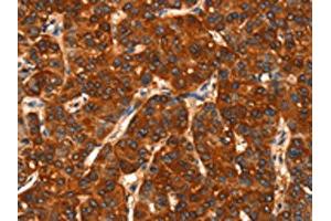 The image on the left is immunohistochemistry of paraffin-embedded Human liver cancer tissue using ABIN7190469(DHH Antibody) at dilution 1/25, on the right is treated with synthetic peptide. (desert Hedgehog antibody)