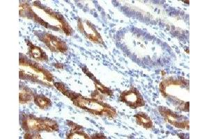 Formalin-fixed, paraffin-embedded human gastric carcinoma stained with Mucin-6 antibody (MUC6/916). (MUC6 antibody)