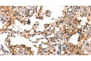 Immunohistochemistry of paraffin-embedded Human thyroid cancer tissue using CUL4B Polyclonal Antibody at dilution 1:50 (Cullin 4B antibody)
