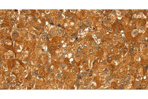 Immunohistochemistry of paraffin-embedded Human liver cancer using PYGM Polyclonal Antibody at dilution of 1:30 (PYGM antibody)