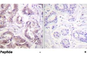 Immunohistochemical analysis of paraffin-embedded human breast carcinoma tissue using BIRC5 polyclonal antibody . (Survivin antibody)