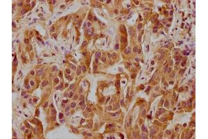 IHC image of ABIN7146186 diluted at 1:300 and staining in paraffin-embedded human liver cancer performed on a Leica BondTM system. (CELSR3 antibody  (AA 514-718))