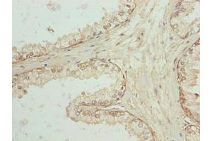 Immunohistochemistry of paraffin-embedded human prostate cancer using ABIN7168900 at dilution of 1:100 (SPTLC3 antibody  (AA 1-58))