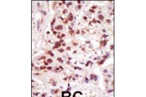 Formalin-fixed and paraffin-embedded human cancer tissue reacted with the primary antibody, which was peroxidase-conjugated to the secondary antibody, followed by DAB staining. (CROT antibody  (C-Term))