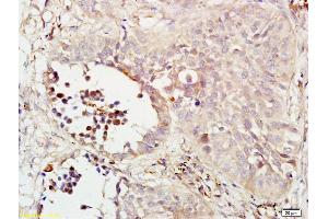 Formalin-fixed and paraffin embedded human lung carcinoma labeled with Rabbit Anti phospho-MEK1/MAPKK1(Ser298) Polyclonal Antibody, Unconjugated (ABIN733703) at 1:200 followed by conjugation to the secondary antibody and DAB staining (MEK1 antibody  (pSer298))