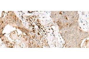 Immunohistochemistry of paraffin-embedded Human esophagus cancer tissue using OVOL2 Polyclonal Antibody at dilution of 1:50(x200) (OVOL2 antibody)