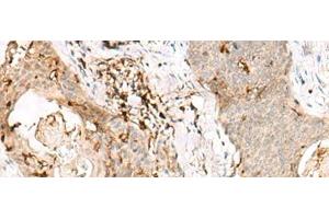 Immunohistochemistry of paraffin-embedded Human esophagus cancer tissue using OVOL2 Polyclonal Antibody at dilution of 1:50(x200)
