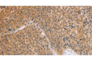 Immunohistochemistry of paraffin-embedded Human liver cancer using BRS3 Polyclonal Antibody at dilution of 1:50 (BRS3 antibody)
