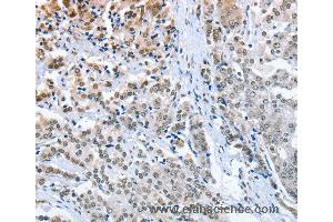 Immunohistochemistry of Human prostate cancer using ELAVL1 Polyclonal Antibody at dilution of 1:50 (ELAVL1 antibody)