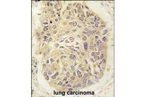 Formalin-fixed and paraffin-embedded human lung carcinoma tissue reacted with FARSA antibody (N-term) (ABIN391817 and ABIN2841665) , which was peroxidase-conjugated to the secondary antibody, followed by DAB staining. (Phenylalanyl-tRNA Synthetase, alpha Subunit (FARSA) (AA 54-83), (N-Term) antibody)