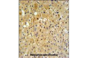 P450R Antibody IHC analysis in formalin fixed and paraffin embedded human hepatocarcinoma tissue followed by peroxidase conjugation of the secondary antibody and DAB staining. (CYP2B6 antibody  (AA 462-488))