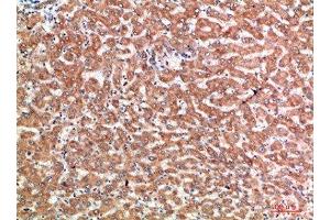 Immunohistochemical analysis of paraffin-embedded human-liver-cancer, antibody was diluted at 1:200 (CD137 antibody  (AA 111-160))