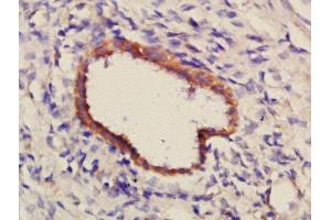 Formalin-fixed and paraffin embedded human glioma tissue labeled with Anti-PCDH7 Polyclonal Antibody, Unconjugated (ABIN1386405) at 1:300 followed by conjugation to the secondary antibody and DAB staining. (PCDH7 antibody  (AA 431-530))
