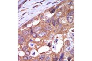 Formalin-fixed and paraffin-embedded human cancer tissue reacted with the primary antibody, which was peroxidase-conjugated to the secondary antibody, followed by AEC staining. (PKC mu antibody  (N-Term))