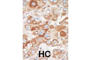 Formalin-fixed and paraffin-embedded human hepatocellular carcinoma tissue reacted with SRPK2 polyclonal antibody  , which was peroxidase-conjugated to the secondary antibody, followed by DAB staining. (SRPK2 antibody  (C-Term))