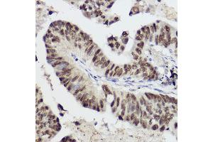 Immunohistochemistry of paraffin-embedded human lung cancer using ST Rabbit pAb (ABIN3020614, ABIN3020615, ABIN3020616 and ABIN6213588) at dilution of 1:50 (40x lens). (STAT1 antibody  (AA 513-712))