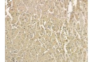 at 1/100 staining human hepatocellular carcinoma by IHC-P. (HCLS1 antibody  (Internal Region))