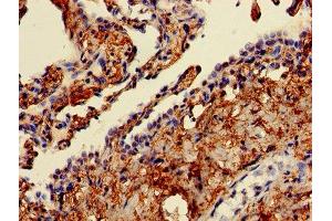 Immunohistochemistry of paraffin-embedded human lung cancer using ABIN7152377 at dilution of 1:100