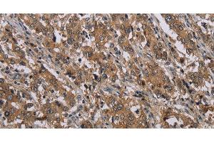 Immunohistochemistry of paraffin-embedded Human liver cancer tissue using MAL Polyclonal Antibody at dilution 1:30 (MAL antibody)
