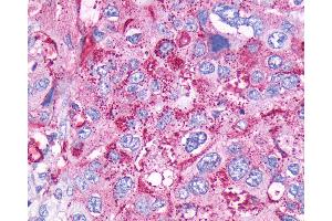 Anti-CCKBR / Cckb antibody IHC of human Pancreas, Carcinoma. (CCKBR antibody  (Cytoplasmic Domain))