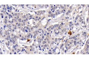Detection of CASP3 in Human Lymphoma Tissue using Monoclonal Antibody to Caspase 3 (CASP3) (Caspase 3 antibody  (AA 29-175))