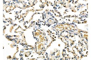 ABIN6263447 and ABIN6278081 at 1/100 staining Human lung cancer and adjacent non-tumor tissue by IHC-P.