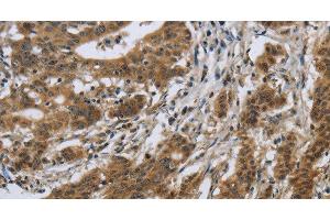 Immunohistochemistry of paraffin-embedded Human gastric cancer using IL5RA Polyclonal Antibody at dilution of 1:40 (IL5RA antibody)