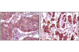 Immunohistochemical analysis of paraffin-embedded human lung carcinoma (left) and breast carcinoma (right) showing cytoplasmic localization using ERK2 mouse mAb with DAB staining. (ERK2 antibody)