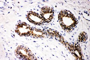 Anti- FHIT Picoband antibody, IHC(P) IHC(P): Human Mammary Cancer Tissue