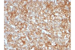 Formalin-fixed, paraffin-embedded human Renal Cell Carcinoma stained with CD147 Mouse Monoclonal Antibody (BSG/963). (CD147 antibody)