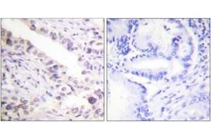 Immunohistochemistry analysis of paraffin-embedded human prostate carcinoma tissue, using Smad2 (Ab-467) Antibody. (SMAD2 antibody  (AA 418-467))