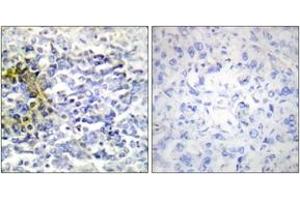 Immunohistochemistry analysis of paraffin-embedded human lung carcinoma tissue, using FXR2 Antibody. (FXR2 antibody  (AA 551-600))